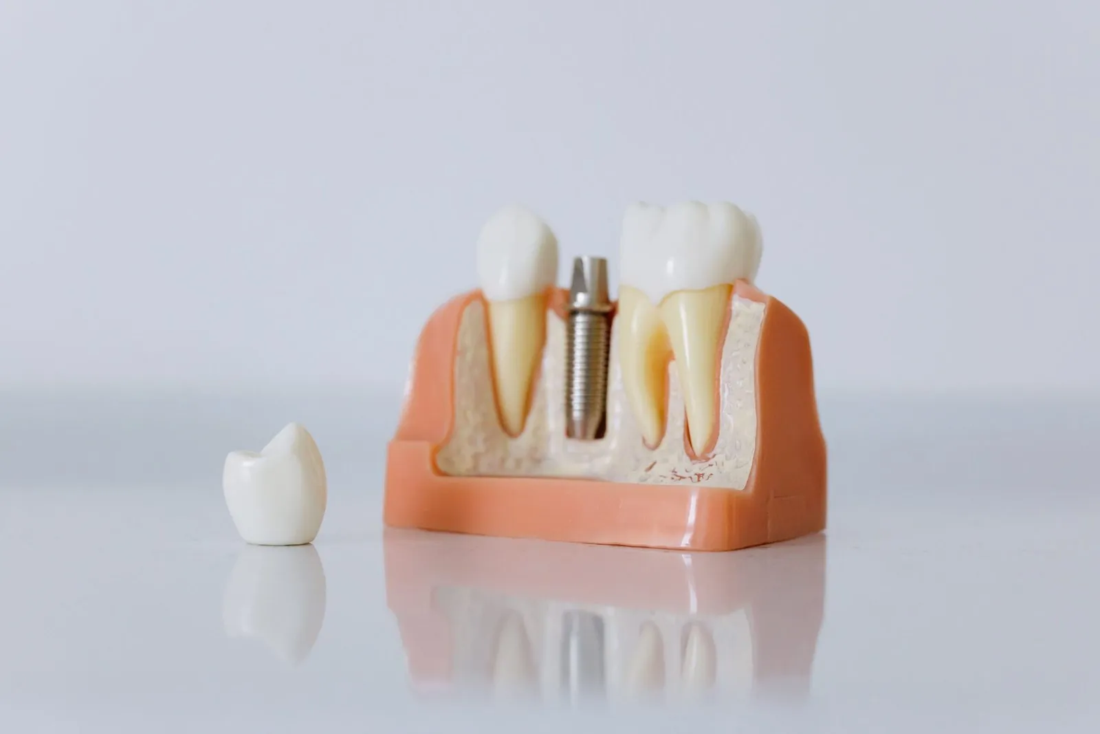 Modello di impianto dentale con corona